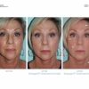 Ageloc Galvanic Spa met Facial Gels - Afbeelding 5